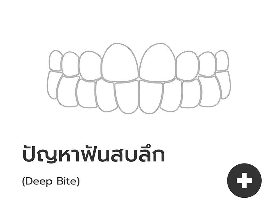ชิ้นงานจัดฟันใส Dentallight ใสสะอาดมองแทบไม่เห็น