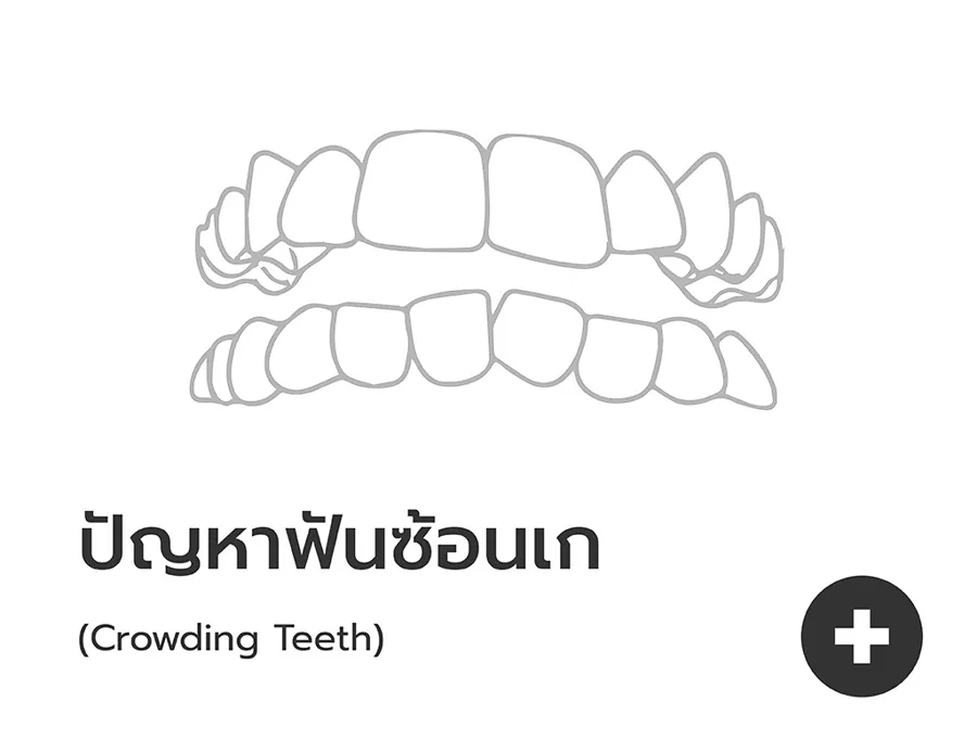 รอยยิ้มมั่นใจหลังเริ่มจัดฟันใสกับ Dentallight