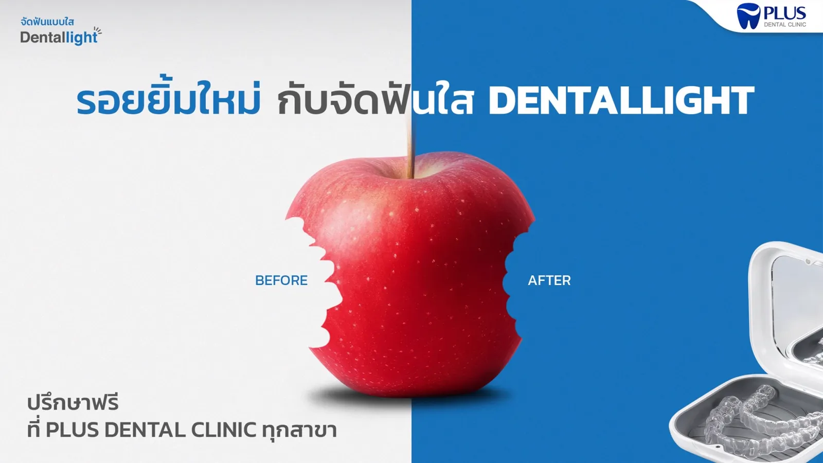 รอยยิ้มใหม่กับจัดฟันใส Dentallight — before / after