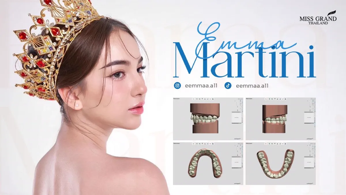 เคสจัดฟันใส Emma Martini Miss Grand Thailand