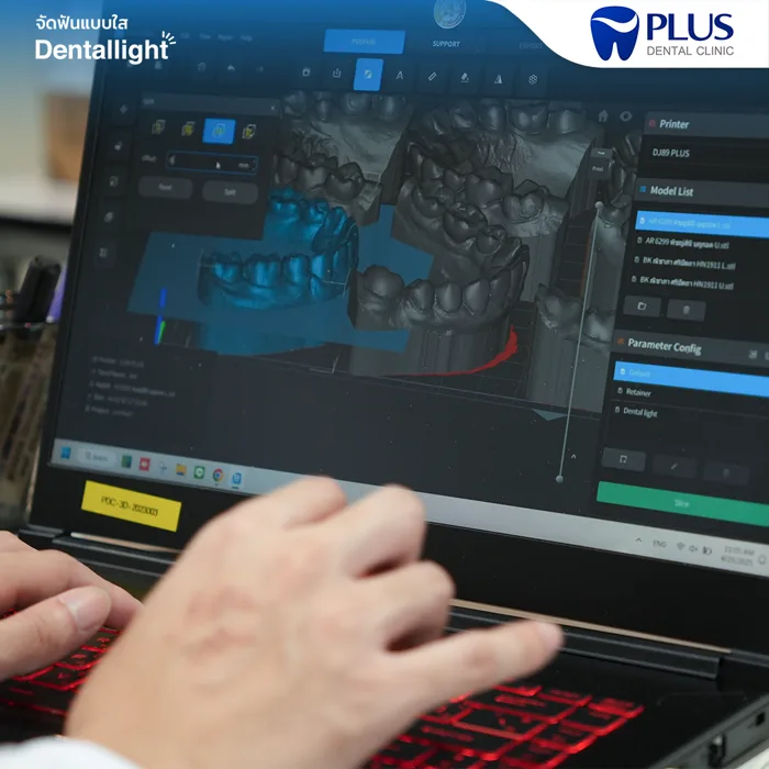 ทีมแล็บ Dentallight ออกแบบชิ้นงานจัดฟันจากไฟล์สแกน 3 มิติ